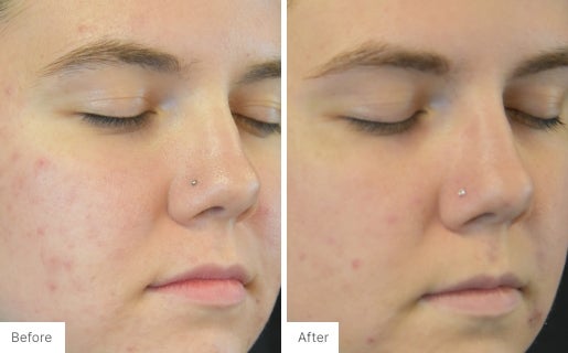 Acne Real Results Image 9
